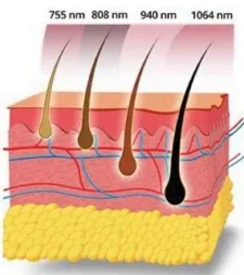 Laser Pro 4 Diode Professionnel Portable – Image 7