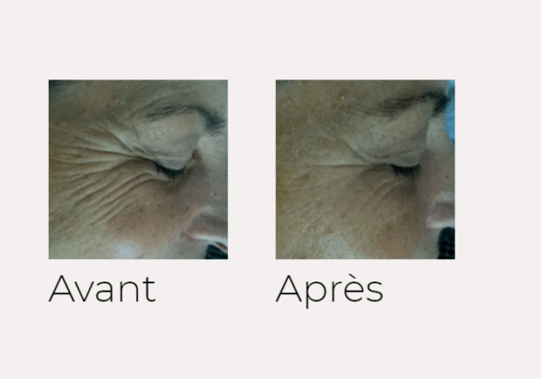 X-Skin Age