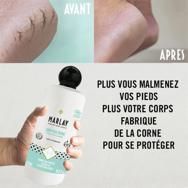 Avant après talon avec callosités et Marlay Soin Peau Neuve 500 ml
